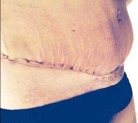 tummy tuck scar