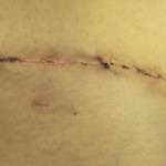 Images of tummy tuck scars (8)