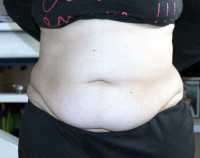Indication for tummy tuck surgery and lipo