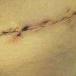 Photo of abdominoplasty scar (1)