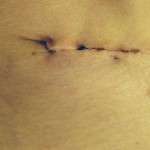 Photo of abdominoplasty scar (6)