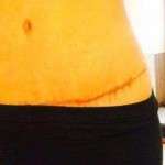 Photos abdominoplasty scar (5)