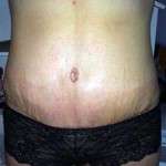 Photos of partial abdominoplasty scar