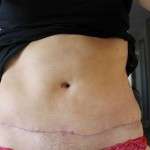 Pics of tummy tuck scars (2)