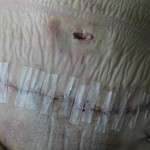 Pics of tummy tuck scars (3)