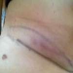Pics of tummy tuck scars (4)