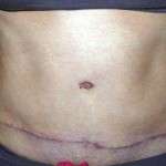 Pics of tummy tuck scars (5)