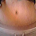 Pictures of tummy tuck scars (1)