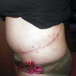 Pictures of tummy tuck scars (2)