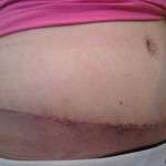 Pictures of tummy tuck scars (4)