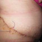 Pictures of tummy tuck scars (5)