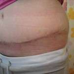 Pictures of tummy tuck scars (6)
