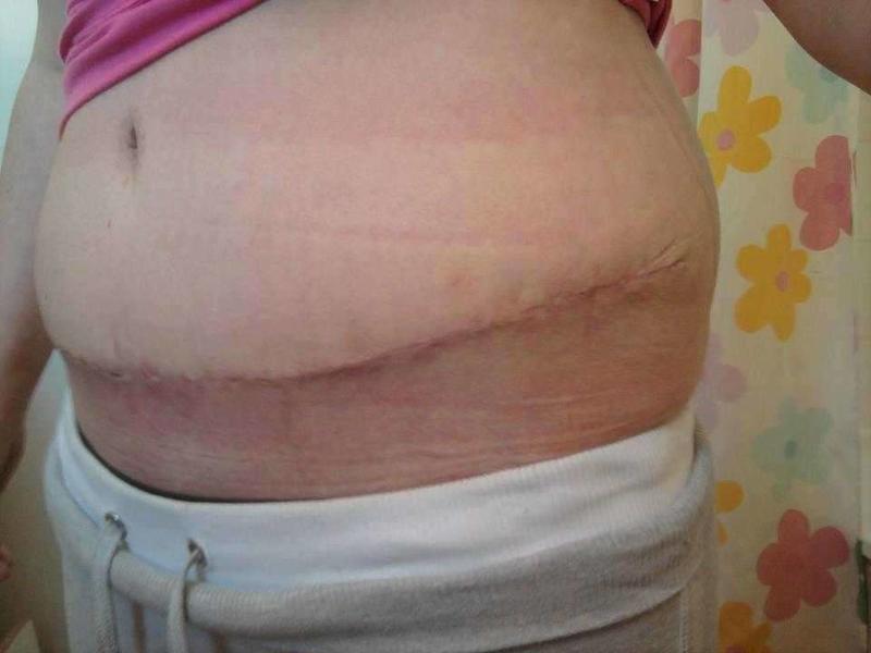 tummy tuck gone wrong photos