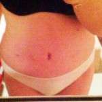 Pictures of tummy tuck scars (7)