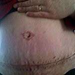 Result after tummy tuck