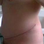 Results after tummy tuck