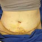 Results of tummy tuck
