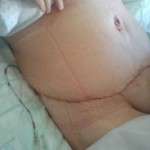 Results of tummy tuck