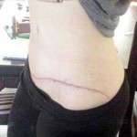Scar after tummy tuck (4)