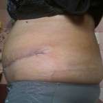 Scar after tummy tuck (5)