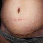 Scar photo from tummy tuck