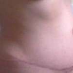 Scars after tummy tuck (5)