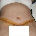 Scars after tummy tuck (6)