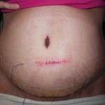 Scars after tummy tuck (7)