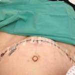 Scars from abdominoplasty
