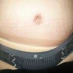 Scars from tummy tuck (1)