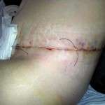 Scars from tummy tuck (3)