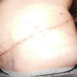 Scars from tummy tuck surgery