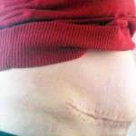 Scars gallery after tummy tuck