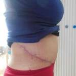 Scars image after tummy tuck