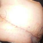 Scars image from tummy tuck