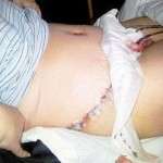 Scars images from tummy tuck