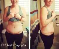 Tummy tuck after weight loss before and after picture