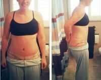 Tummy tuck after weight loss midicare