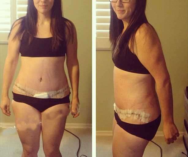 Tummy Tuck After Weight Loss Pics Tummy Tuck Prices