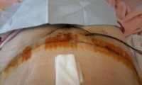 Tummy tuck complications sealing of scars