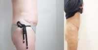 Tummy tuck dog ears before and after