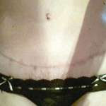 Tummy tuck photo scar