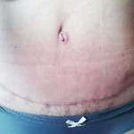 Tummy tuck photos scar (3)