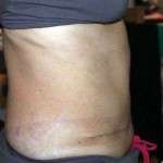 Tummy tuck pictures scars (1)