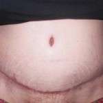 Abdominoplasty results