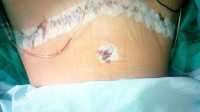 Tummy tuck scar aftercare