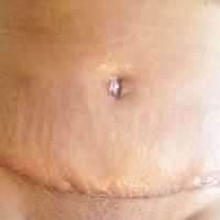 Tummy tuck scar and liposuction