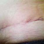 Tummy tuck scars image