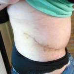 Tummy tuck scars photos