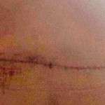 Tummy tuck scars photos (4)